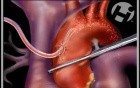 Ventricular Septal Defect