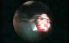 Bleeding From The Middle Ear During Modified Radical Mastoidectomy (MRM)