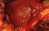 Mandibular Ameloblastoma - Resection And Recontruction
