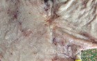 Small Gastric Adenocarcinoma of the Diffuse Ring Cell (11 of 19)