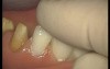 Glass Ionomer Cementation (2/6)