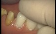 Glass Ionomer Cementation (2/6)
