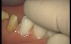 Glass Ionomer Cementation (2/6)