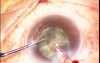 Phacoemulsification With Ozil IP
