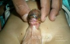 Penis Injury  Necrotic Tissue Present