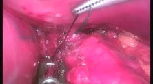 Fundoplication - SILS