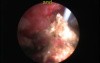 PCNL - Flexible Nephroscope