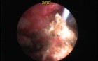 PCNL - Flexible Nephroscope