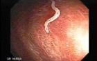 Trichuriasis infection 