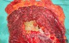 Multiple Rectal Ulcers (87 of 110)