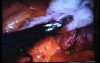 Jejunal Gastrointestinal Stromal tumor (GIST) (81 of 86)
