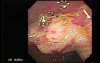Cap polyposis that resemble a adenocarcinoma of the rectum (3 of 7)