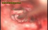 Stapedectomy - Type IV A Footplate