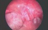 Laparoscopic Appendectomy