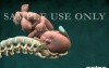 Birth Injury - Shoulder Dystocia With Brachial Plexus Stretching (Uterus Removed)