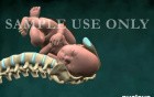 Birth Injury - Shoulder Dystocia With Brachial Plexus Stretching (Uterus Removed)