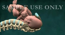 Birth Injury - Shoulder Dystocia With Brachial Plexus Stretching (Uterus Removed)