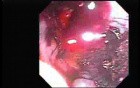Hemorrhage After Ligation - Varix with a Blood Clot