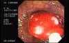 Tubulo - Villous Adenoma - Endoscopy (22 of 28)