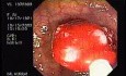 Tubulo - Villous Adenoma - Endoscopy (22 of 28)