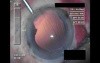 Cataract Surgery - Part 5