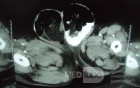 CT Abdomen In Patient With Bilateral Inguinal Hernia 