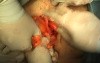 Prolapse of the Uterus - Sling Procedure, Part 2