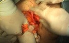 Prolapse of the Uterus - Sling Procedure, Part 2