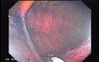 Sessile Tubulovillous Adenoma (10 of 13)
