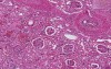 Kidney - Chronic Transplant Rejection