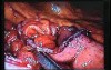 Jejunal Gastrointestinal Stromal tumor (GIST) (48 of 86)