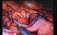 Jejunal Gastrointestinal Stromal tumor (GIST) (48 of 86)
