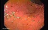 Percutaneous Endoscopic Gastrostomy - PEG (1 of 6)