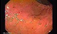 Percutaneous Endoscopic Gastrostomy - PEG (1 of 6)