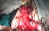 Radical Surgery of the Uterus - Ureteric Canal Dissection