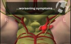 Aneurysm Leak