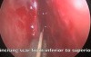 Massive Scarring In The Nasal Cavity - FESS