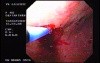Gastric Angiodysplastic Lesions - Argon Plasma Coagulation (1 of 3)