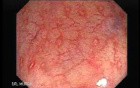 Crohn´s Colitis (1 of 3)