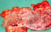 Severe case of Ischemic Colitis (18 of 19)