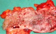 Severe case of Ischemic Colitis (18 of 19)