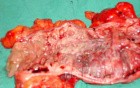 Severe case of Ischemic Colitis (18 of 19)
