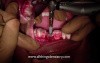 Computer Aided Implant Surgery - Placing The Implant - Finally