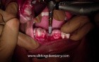 Computer Aided Implant Surgery - Placing The Implant - Finally