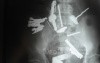 Multiple Foreign bodies in the GI tract (6 of 12)
