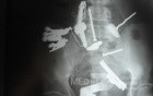 Multiple Foreign bodies in the GI tract (6 of 12)