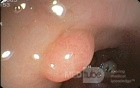 Polyp Of The Sigmoid Colon