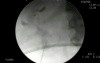 Percutaneous Nephrolithotomy - Direct Access