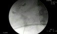 Percutaneous Nephrolithotomy - Direct Access