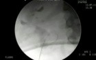 Percutaneous Nephrolithotomy - Direct Access